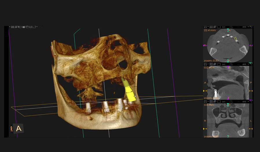 Tomografía volumétrica ambos maxilares (planificación de implantes)