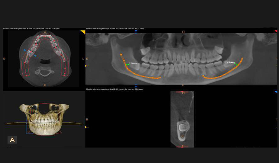 Tomografía volumétrica ambos maxilares